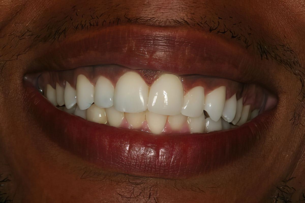 Gables Perfect Smile patient, Alex, after crowns