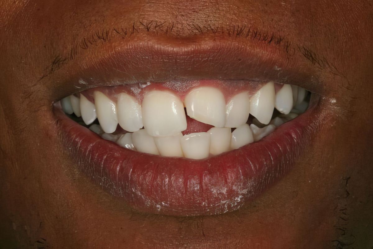 Gables Perfect Smile patient, Alex, before crowns