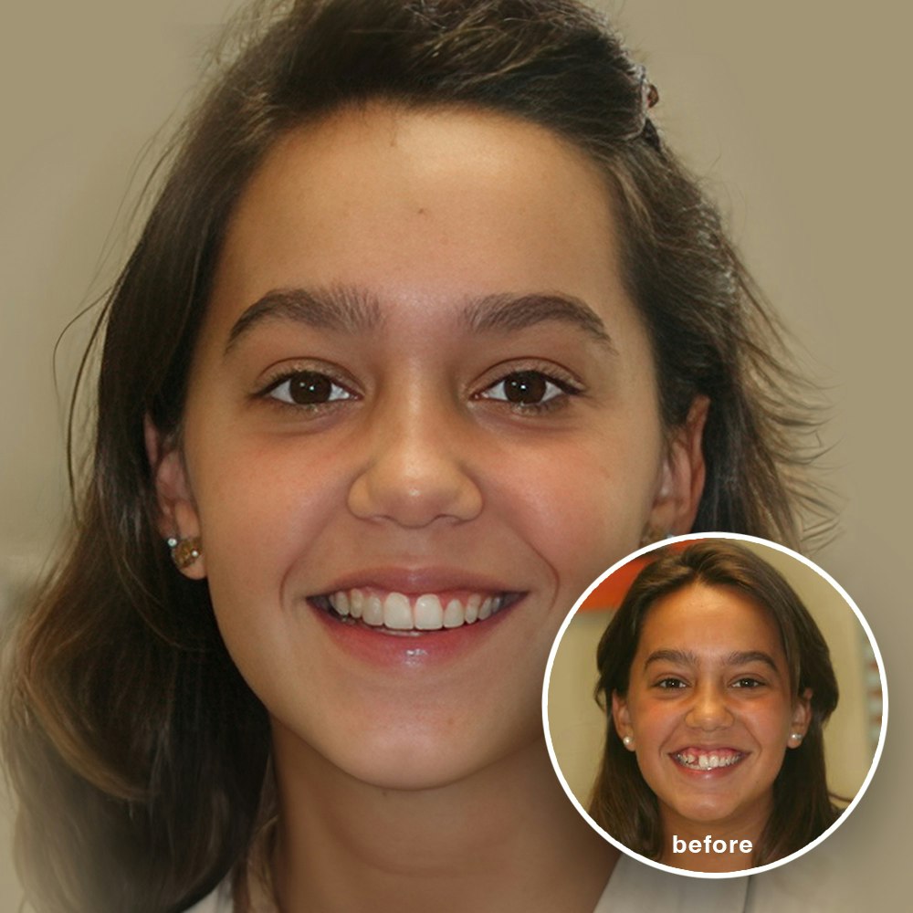 a woman getting gum surgery