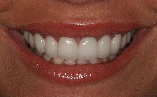 After veneers