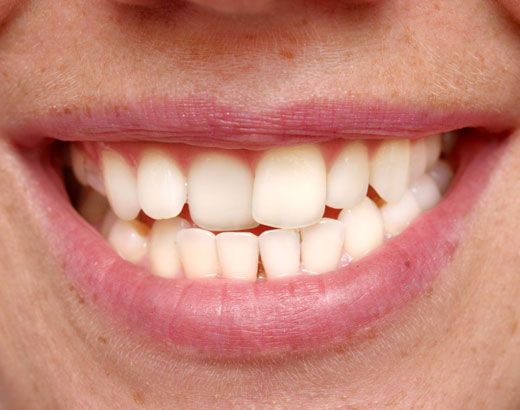 A patient with crowded teeth