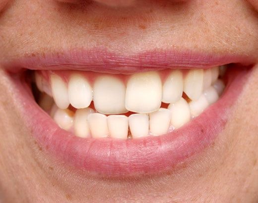 A patient with crowded teeth