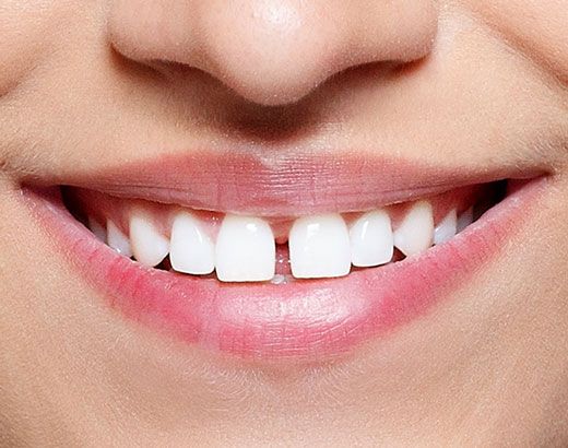 A patient with gapped teeth