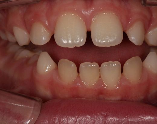 A patient with an open bite