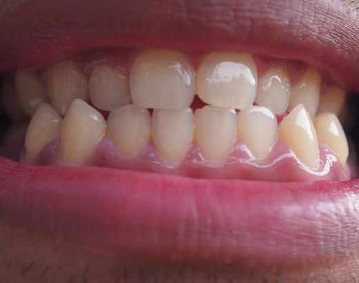 A patient with a crossbite