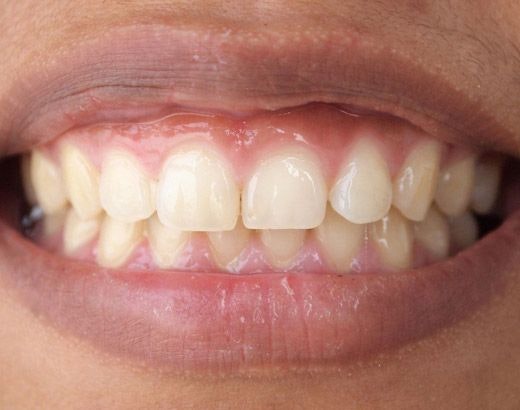 A patient with an overbite