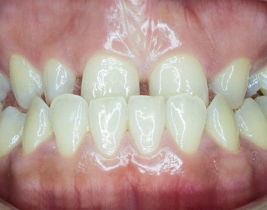 A patient with an underbite