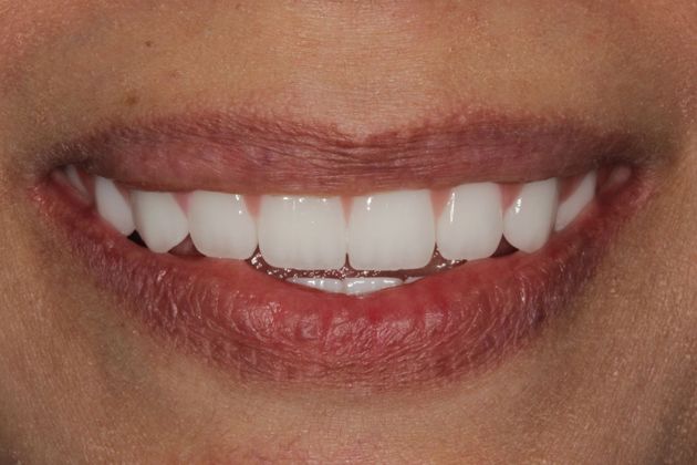 Patient after implants, with a full smile