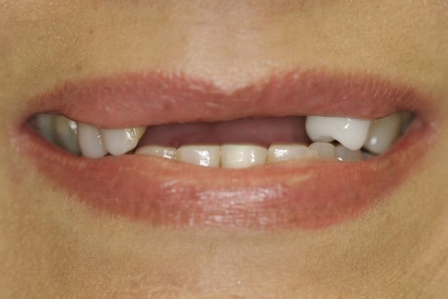 Patient before implants, with missing front teeth