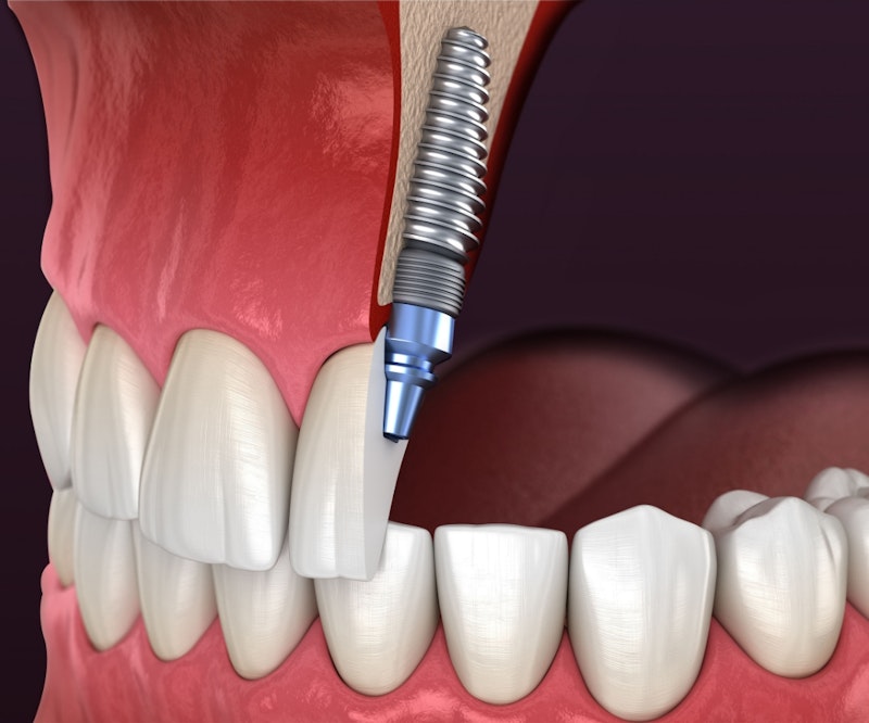 single tooth implants