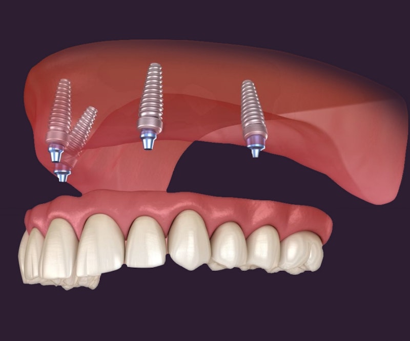 full arch implants
