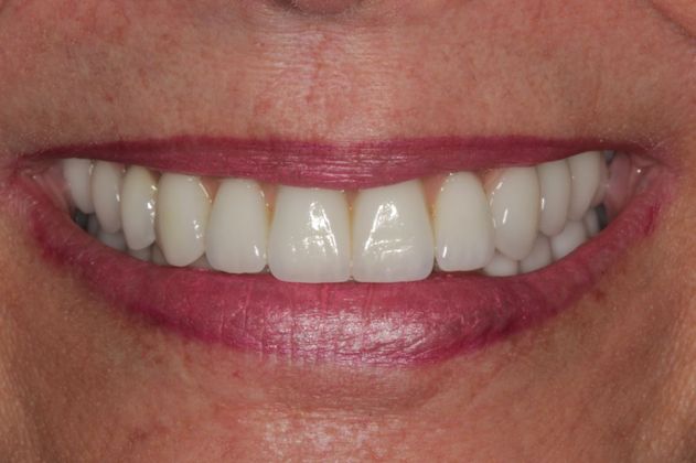 Upper Implant with Full Mouth Rehabilitation After Photo