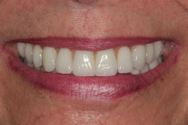 After full mouth reconstruction at the Cosmetic Dentistry Institute