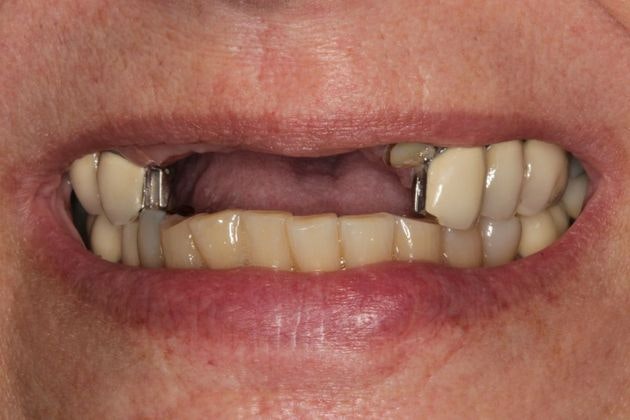 Upper Implant with Full Mouth Rehabilitation Before Photo