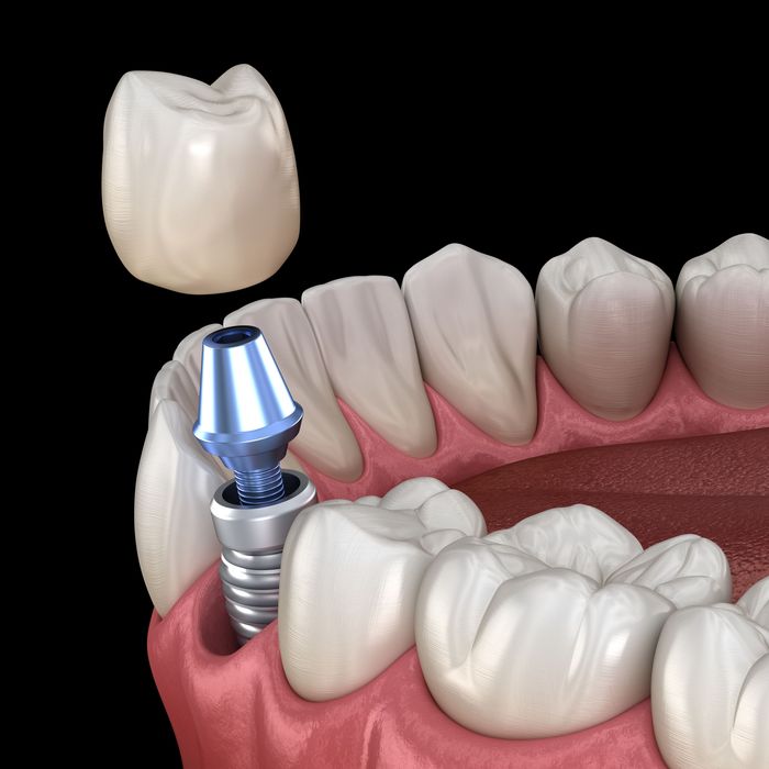 Dental Implants