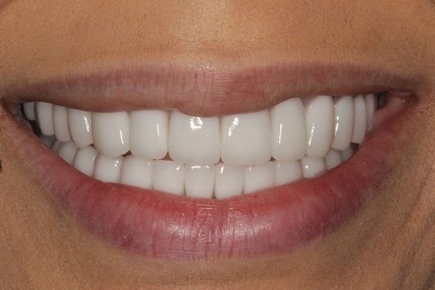 After treatment