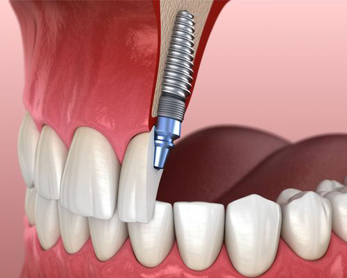Cut-out illustration showing a dental implant secured into jaw