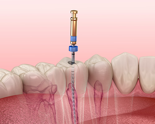 Illustration of infected root canal