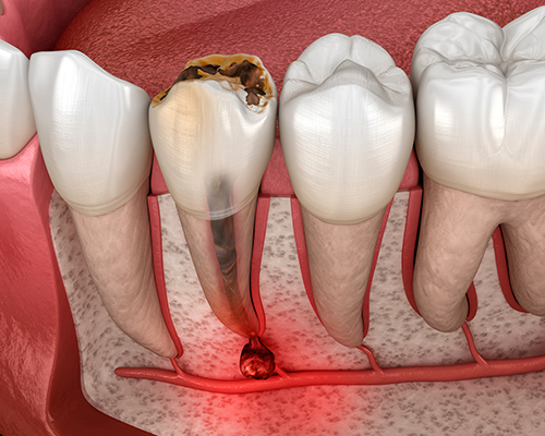 Severely decayed tooth