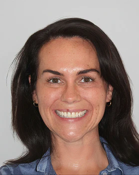 Michelle before Invisalign