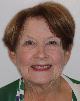 Linda before full mouth reconstruction