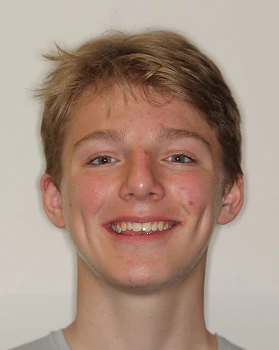 Jayse before Invisalign and veneers