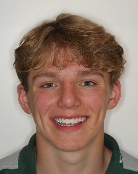 Jayse after Invisalign and veneers