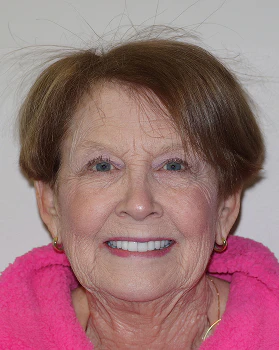 Linda after full mouth reconstruction