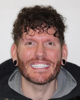 Travis before smile makeover