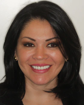 after porcelain veneers