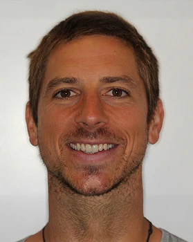 after veneers revision