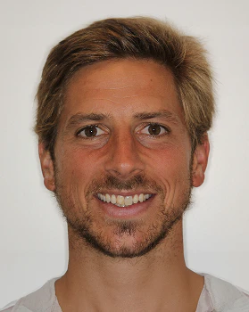 before veneers revision