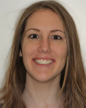 before veneers and invisalign