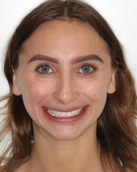 before dental bonding