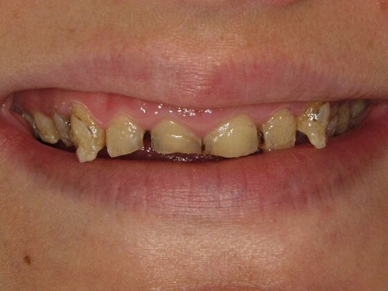Before photo of a smile makeover using porcelain veneers and crowns