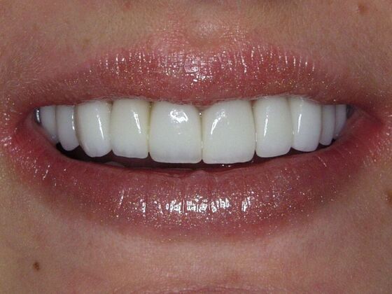 Before photo of a smile makeover using porcelain veneers and crowns