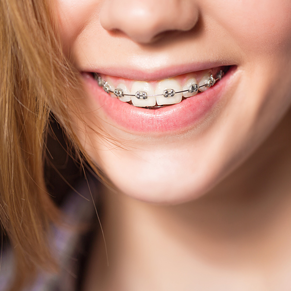 Adult smiling with braces