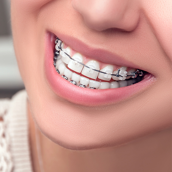Woman smiling with Damon clear braces