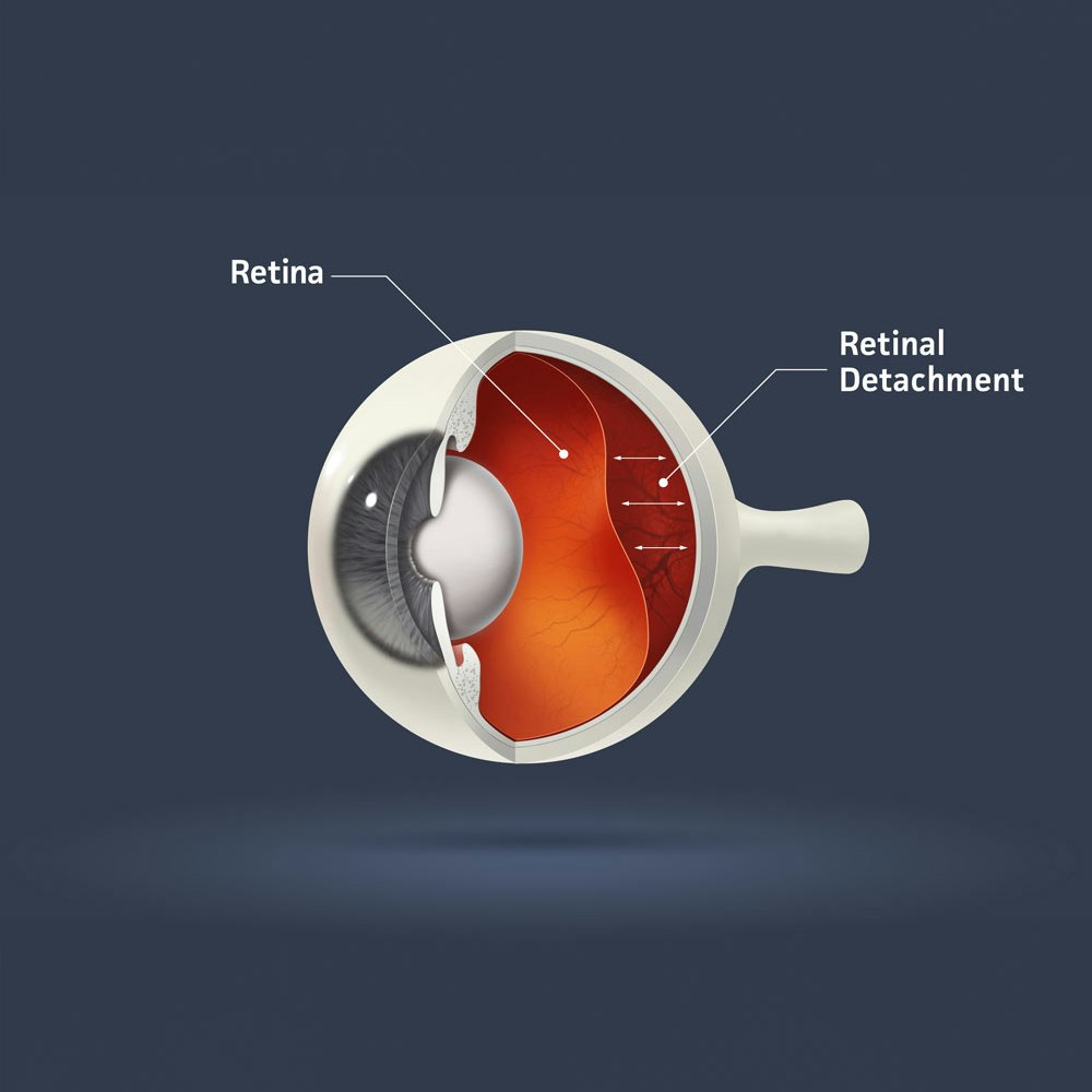 retinal detachment illustration