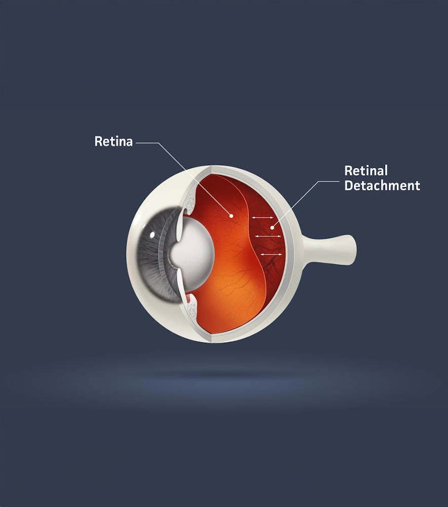 retinal detachment illustration