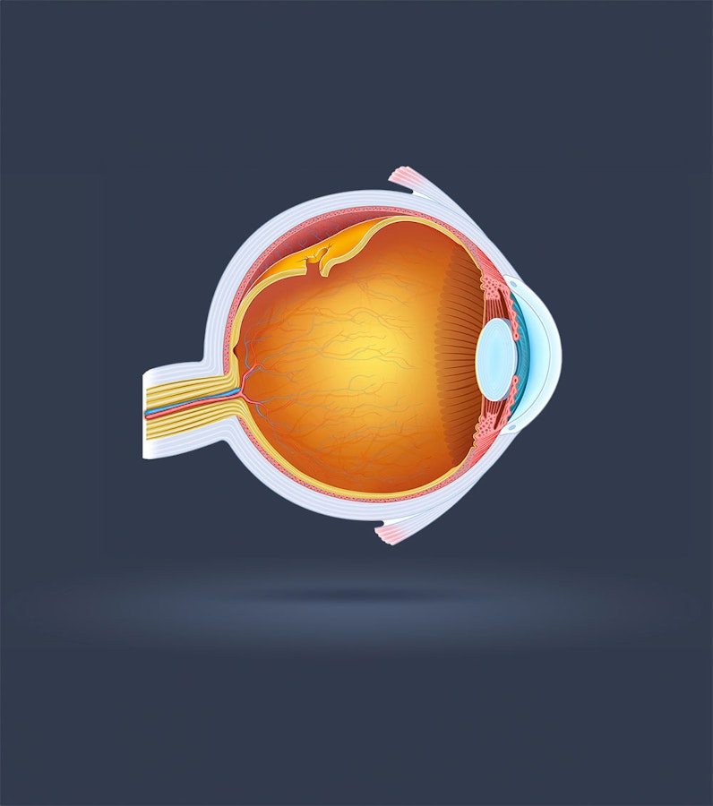 Retinal tear illustration