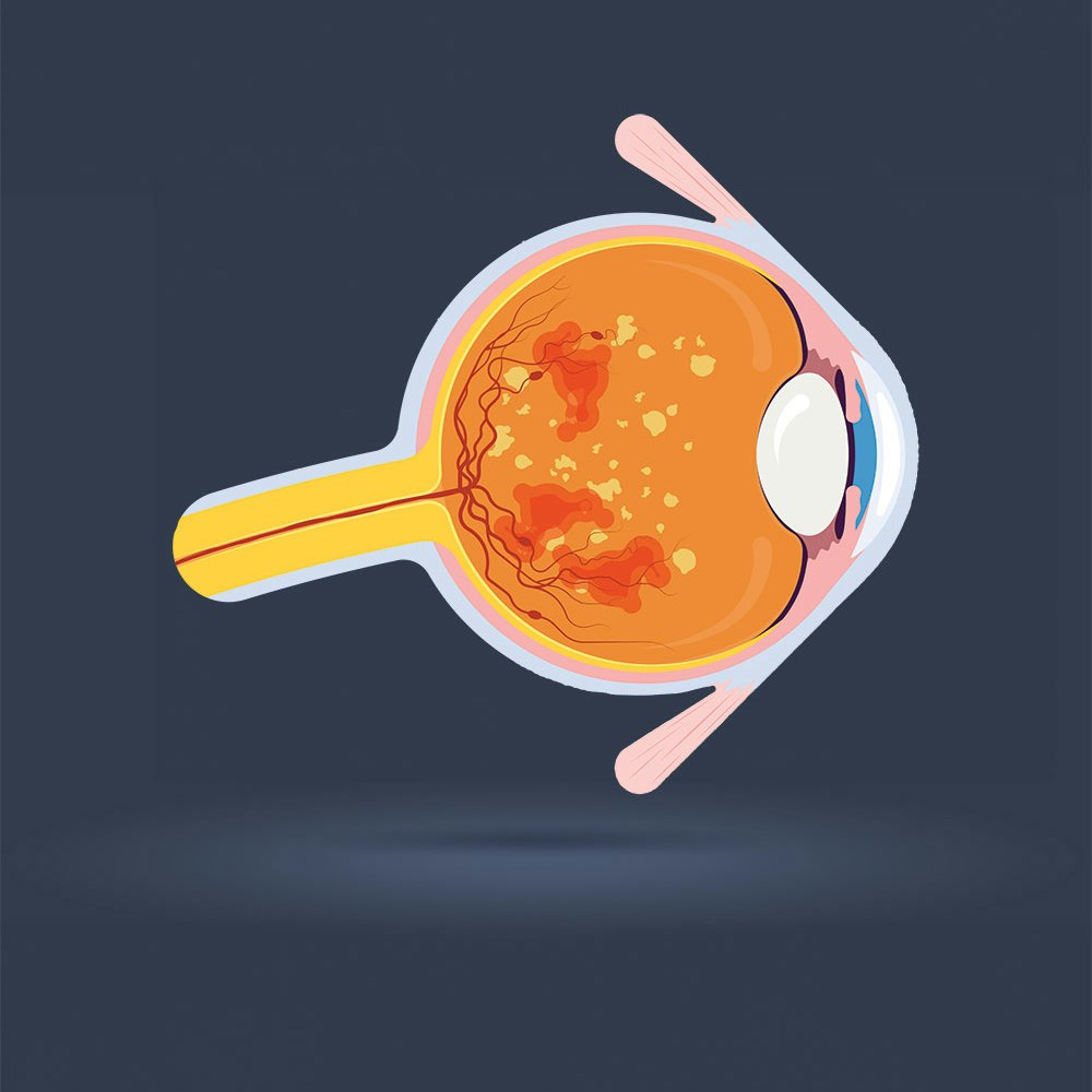 diabetic retinopathy illustration