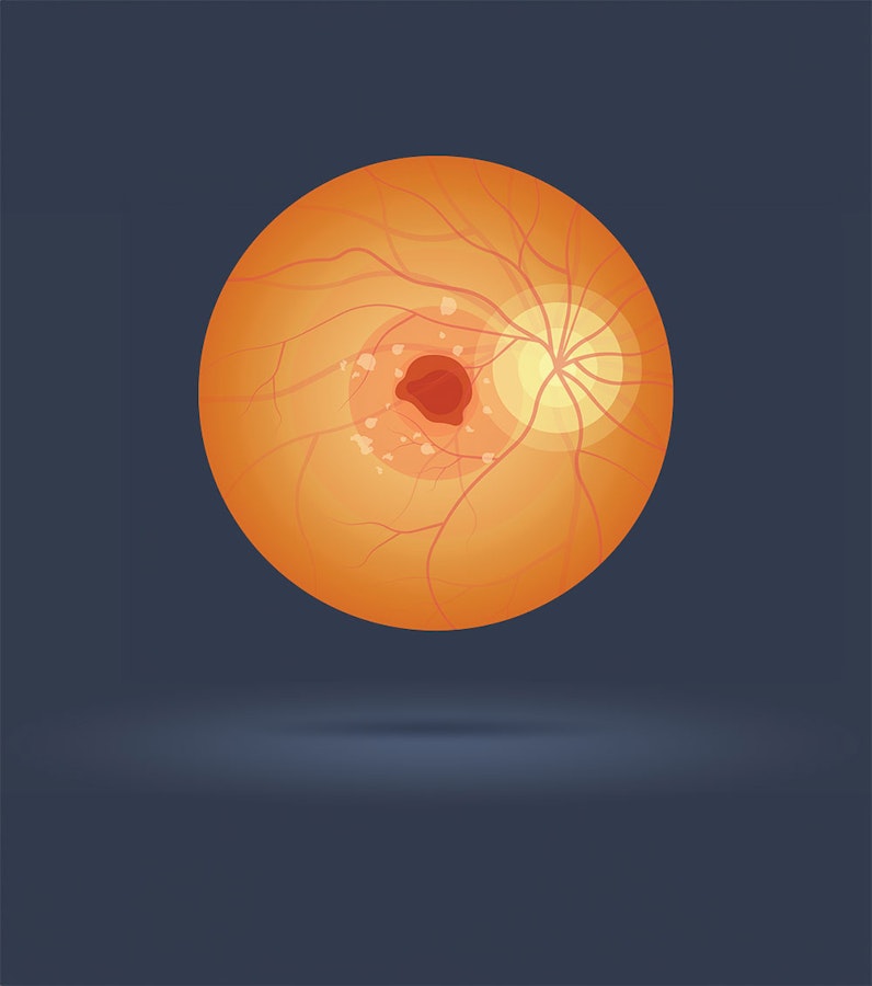 macular degeneration illustration