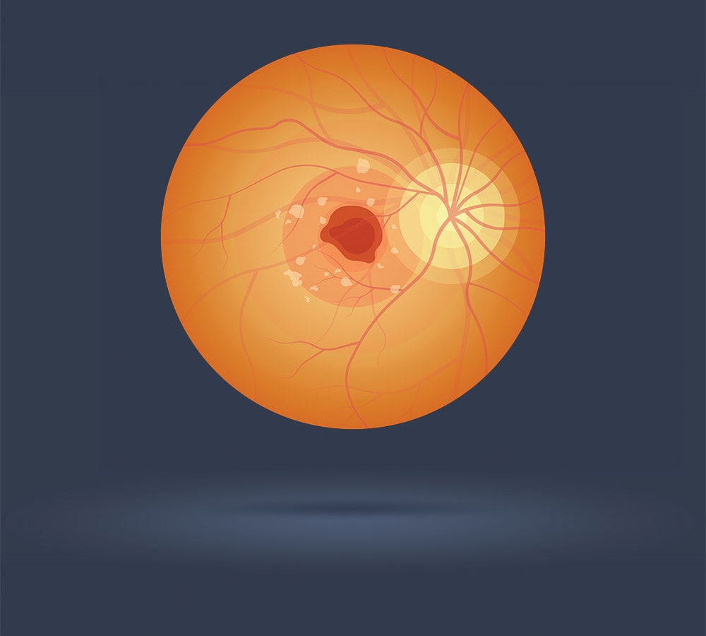 macular degeneration illustration