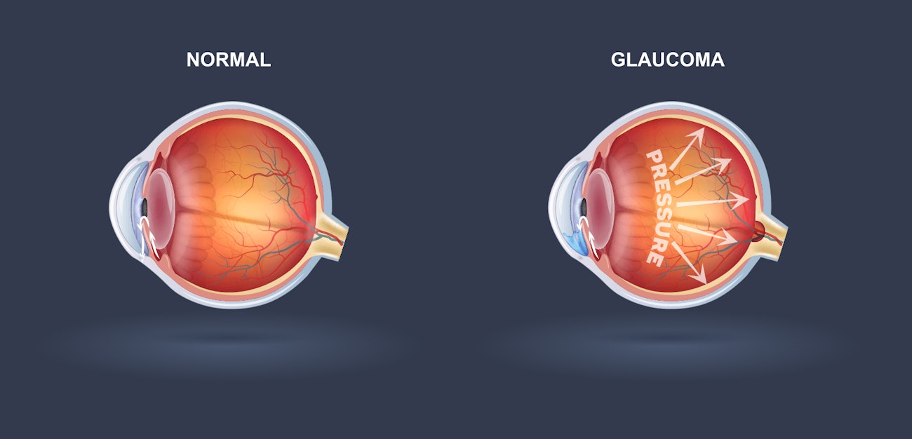 Glaucoma Huntsville, AL - Maynor & Mitchell Eye Center