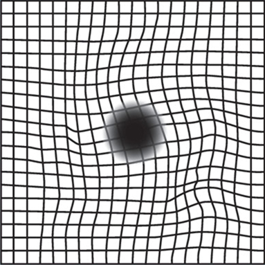 Distorted eyesight when viewing Amsler grid
