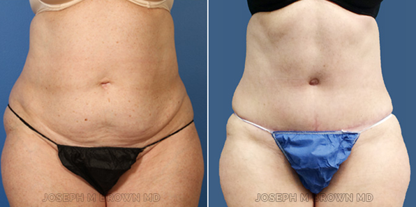 Mini Tummy Tuck - patient before and after picture front view