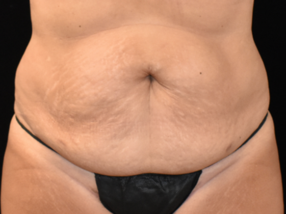 Dr. Joseph Brown's patient before tummy tuck