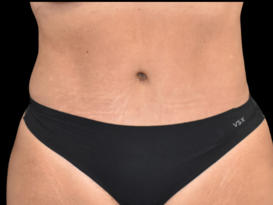 Dr. Joseph Brown's patient after tummy tuck