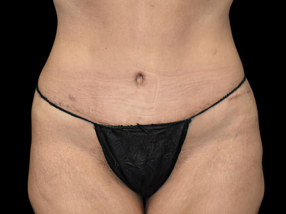 Tampa patient after tummy tuck with Dr. Brown